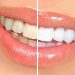 Tout savoir sur le blanchiment dentaire professionnel | Centre Dentaire Michlifen Agdal