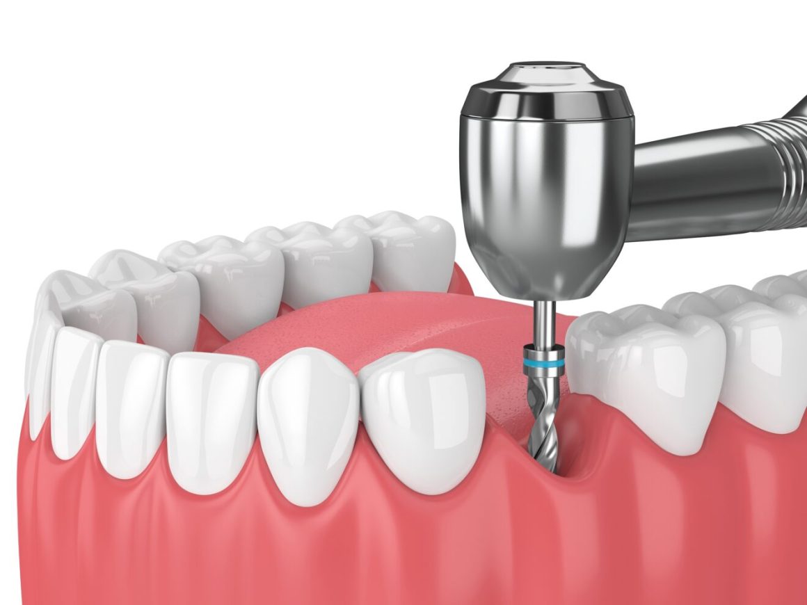 Implant dentaire : comment se déroule la pose étape par étape ?