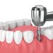 Implant dentaire : comment se déroule la pose étape par étape ?